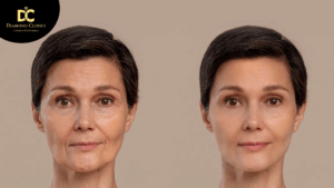 Plasma Lifting Before and After